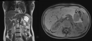 MRI: 5cm large, well-defined, encapsulated tumour with solid-cystic component.