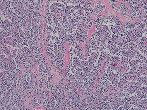 Histologic appearance of the surgical specimen: pseudopapillary pattern with small nuclei and no atypia (some with longitudinal fissures), with the presence of hyaline globules (haematoxylin–eosin ×10).