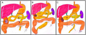 (A) Tumour implant anterior to the right kidney (solid arrow); (B) fibrosis at the pole of the right kidney (solid arrow), causing obstruction of the afferent loop (dashed arrow) and internal hernia of jejunal loops through the transmesocolic orifice (dotted arrow); (C) fibrosis at the pole of the right kidney (solid arrow), side-to-side jejunojejunal anastomosis of the afferent loop (dashed arrow), and reduction of jejunal loops with closure of the transmesocolic “buttonhole” (dotted arrow).