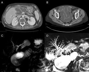 (A) Cross-sectional CT scan showing dilatation of the afferent loop and Wirsung duct; (B) cross-sectional CT image showing dilatation of jejunal loops in the pelvis; (C and D) reconstruction of MRCP showing obstruction of the afferent loop with dilatation of the Wirsung duct and extra- and intrahepatic bile duct.