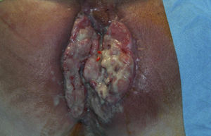 Squamous carcinoma of the anus developed over perianal Crohn's disease.