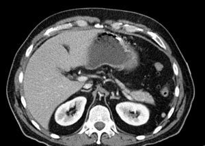 Abdominal-pelvic CT scan identifying the aortic spasm.