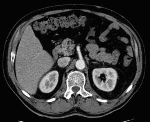 Abdominal-pelvic CT scan after the remission of symptoms and normalisation of analytical parameters.