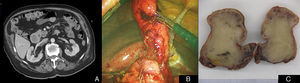 (A) CT; (B) polyp in the gastric-pyloric junction. (C) Macroscopic appearance of the tumour.