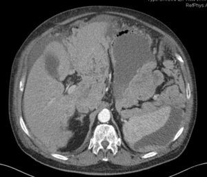 Hemoperitoneum and metastatic infiltration of the round ligament of the liver.