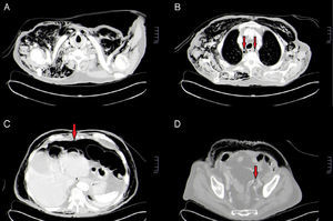 (A) Axial CT image showing anterior and posterior supraclavicular cervical emphysema; (B) axial CT image showing pneumomediastinum (arrows); (C) axial CT scan showing moderate pneumoperitoneum (arrow); (D) axial CT image showing a minimal extraluminal bubble in the vicinity of the colorectal anastomosis (arrow).