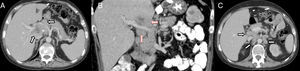 Axial (A) and coronal (B) CT scan with IVC: poorly defined lymph node conglomerate in the hepatic hilum surrounding the hepatic artery (white arrows in A) and the portal vein (red arrows in B); hypodense central area corresponding with necrosis (asterisk in A). Axial CT scan with IVC (C): multiple lymphadenopathies in the hepatic hilum, interaortocaval region and left lateral aortic (arrows).