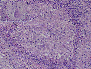 Non-caseating granuloma formed by microscopic aggregation of macrophages that transform into epithelial-like cells surrounded by mononuclear leukocytes (lymphocytes and plasma cells) (×20). Inset: fused epithelioid cells creating a giant multinucleated cell (haematoxylin–eosin×40).
