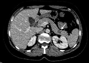 Portal venous phase CT image showing a small, round, hypodense, lesion that is rather well defined between the body and tail of the pancreas.