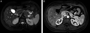 T2-weighted axial image with fat suppression (A) showing evidence of a heterogenous pancreatic mass that is predominantly hyperintense, with hypovascular enhancement in the arterial phase of the dynamic sequences with T1-weighted contrast enhancement (B).