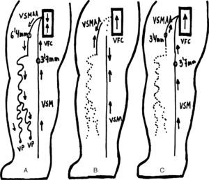 Patient mapping with varicose tributaries of the saphenous vein: (A) baseline situation of AASV-related varicose veins; (B) CHIVA cure 1+2 (traditional), non-haemodynamic approach: crossectomy of the saphenofemoral junction and disconnection of the varicose veins from the AASV and extensive phlebectomy; (C) haemodynamic CHIVA cure (innovative procedure): disconnection of the varices from the AASV and extensive phlebectomy.