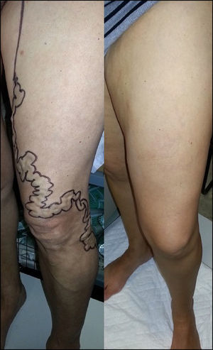 One-year results after surgery: image showing varicose tributaries of the AASV; the left image shows the preoperative mapping, and situation 12 months after surgery is on the right.