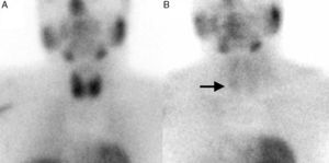 Dual-phase 99mTc-MIBI parathyroid scintigraphy: (A) early phase; (B) late phase showing an accumulation of radiotracer in the lower pole of the right thyroid.