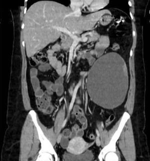 Coronal CT scan showing the unilocular cystic lesion located in the left flank; one of the endophytic solid papillary projections is also observed.