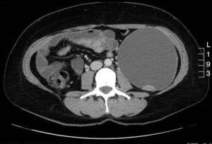 Cross-sectional CT image showing a cystic lesion exerting a mass effect on the left psoas muscle and repelling the bowel loops, with no signs of infiltration.