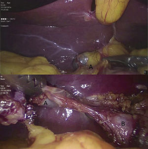 Intraoperative image showing the hypoplastic gallbladder (above, A) with no evidence of the gallbladder bed, as would be typical of porcelain gallbladder; the lower postoperative image shows (after dissection) the communication between the gallbladder (A) and the main bile duct (B), with the cystic duct and artery present.