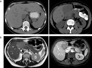 (A) Hepatic tomography showing multiple hypodense focal lesions, two of which are especially large: one measuring 2.5cm in segment II and another measuring 6cm proximal to the caudate lobe; (B) Magnetic resonance showing mildly hyperintense liver lesions in the in-phase T1 sequence (a) and a notable loss of signal in the opposed-phase T1 sequence (b), where they appear hypointense.