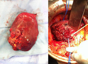 Surgical specimen and site of liver resection.