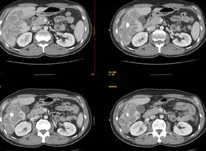 CT images showing pseudotumour of the liver with central calcification.