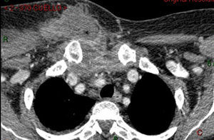 Breast abscess connected with the superior mediastinum.