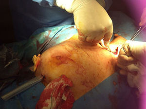 Multiple incisions to drain a breast abscess.