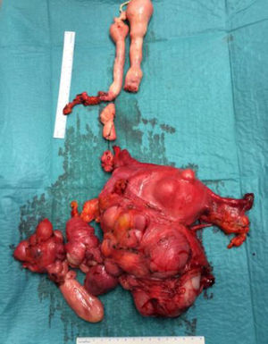 Surgical specimen with a large uterine mass and tumour growth in the iliac veins, cava and right atrium.