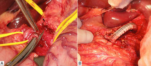 (A) Division of the median arcuate ligament; and (B) stent bypass from the supracoeliac aorta up to the trifurcation of the coeliac trunk.