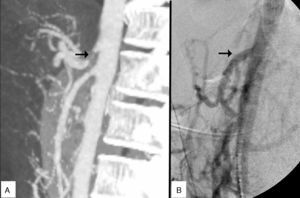 (A) Early-onset occlusion of the coeliac trunk after simple percutaneous angioplasty; and (B) optimal intraoperative arteriography study of the stent bypass from the supracoeliac aorta up to the trifurcation of the coeliac artery.