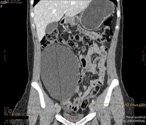 Computed tomography scan showing the retroperitoneal cystic mass in the right anterior renal region measuring 16cm×12cm×6cm, with homogenous density.