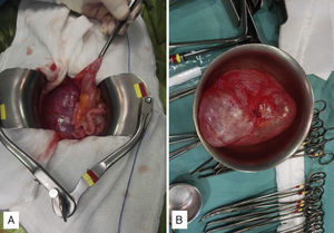 (A) Intraoperative image of the mass: note the medial displacement of the colon (held with forceps) and the small bowel and (B) whole surgical specimen, which is cystic in consistency.