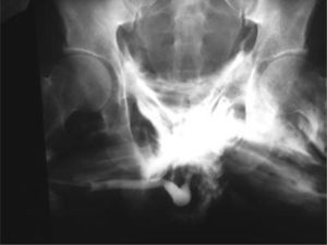 Retrograde urethrography showing damage to the urethra; extravasation of contrast material is observed in the pelvis and perineum.