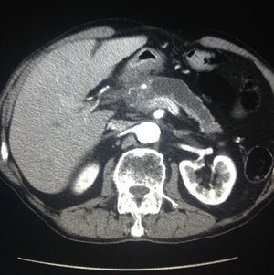 CT with contrast and cystic image in the head of the pancreas with dilatation of the pancreatic duct (case 4).