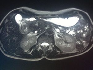 MRI showing a multicystic mass in the head of the pancreas infiltrating the duodenum (case 5).
