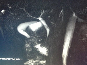 MR cholangiography demonstrating narrowing of the distal common bile duct and thickening of the duodenal wall (case 2).