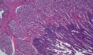 Thickened mucosa of the minor duodenal papilla presenting severe hyperplasia of the Brunner glands.