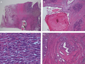 (A) Cyst with thick secretions situated in the muscle plane beneath a very thick mucosa with prominent Brunner glands; (B) dilated duct with secretions in the atrophic pancreatic tissue; (C) active myofibroblastic proliferation with eosinophils and some mitoses; (D) heterotopic pancreatic tissue in the duodenal wall.