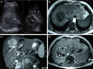(A) B-mode ultrasound (left) shows a lesion with poorly defined edges and thin peripheral enhancement after the administration of contrast (right); (B–D) focal lesion in the RHL, hypointense in T1 (arrow in B) and hyperintense in T2 (arrow in C). The contrast study (D) shows peripheral uptake with irregular septa in its interior (arrow) in the portal phase.