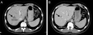 Abdominal–pelvic CT with IV contrast 6 months later (A) showing significant reduction in the hepatic lesion (arrow); at the annual follow-up (B), the lesion is smaller than 1cm.