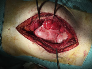 Image from the surgery showing a pearly membrane encompassing the small intestine.