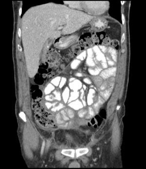 CT image: encapsulated conglomeration of small intestinal loops.