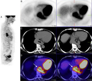 PET/CT scan with FDG, in sagittal PET (A), axial PET (B), axial CT (C) projections and a superimposed PET-CT image (D) showing increased metabolic activity in the lower third of the oesophagus and in the oesophagogastric junction, with a notable increase in the thickness of the oesophageal and gastric wall.