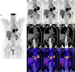 PET/CT image with FDG, in coronal PET (A and B) and coronal CT (C) projections and superimposed PET-CT image (D) showing increased metabolic activity in the lower mediastinum, affecting the entire lower third of the oesophagus to the oesophagogastric junction.