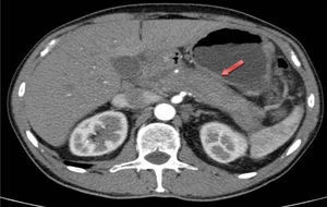 CT image showing the pancreatic gland that is increased in size.