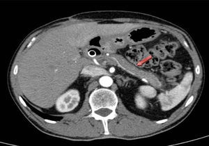 CT image demonstrating the decrease in the inflammatory process after the initiation of corticosteroid therapy.