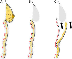 Planning an abdominal advancement flap: (A) the dissection of an abdominal advancement flap is based around the muscle perforators of the abdominal wall; (B) subcutaneous detachment at the muscle plane is able to free the covering skin to be mobilized toward the thoracic defect (C).