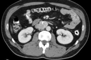 CT angiography image of the interaortocaval tumor.