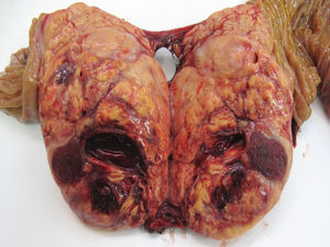 Macroscopic sample of a G1 neuroendocrine tumour (WHO, 2010) located in the head of the pancreas.