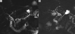 (A) MRCP: beaded dilatation of the main pancreatic duct compatible with main-branch IPMN. (B) MRCP: image of a polylobate cyst connecting with the main pancreatic duct compatible with secondary-branch IPMN.