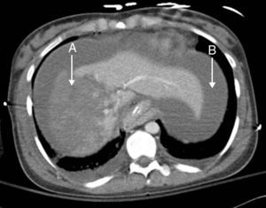 CT cross-section: (A) liver laceration in the right hepatic lobe (grade IV of the AAST liver injury scale). (B) Intraperitoneal free fluid compatible with hemoperitoneum.