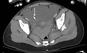 CT cross-section: the arrow points the presence of the femoral venous catheter within the peritoneal cavity.